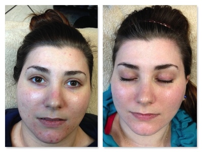 Before and After of Acne Treatment on Face