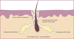 First Stage of Acne First Stage of Acne