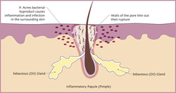 Inflammatory Papule Inflammatory Papule