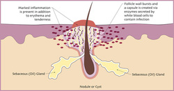 Nodule or cyst Nodule or cyst