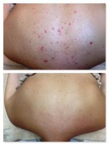 Before and After of Acne Treatment on Back