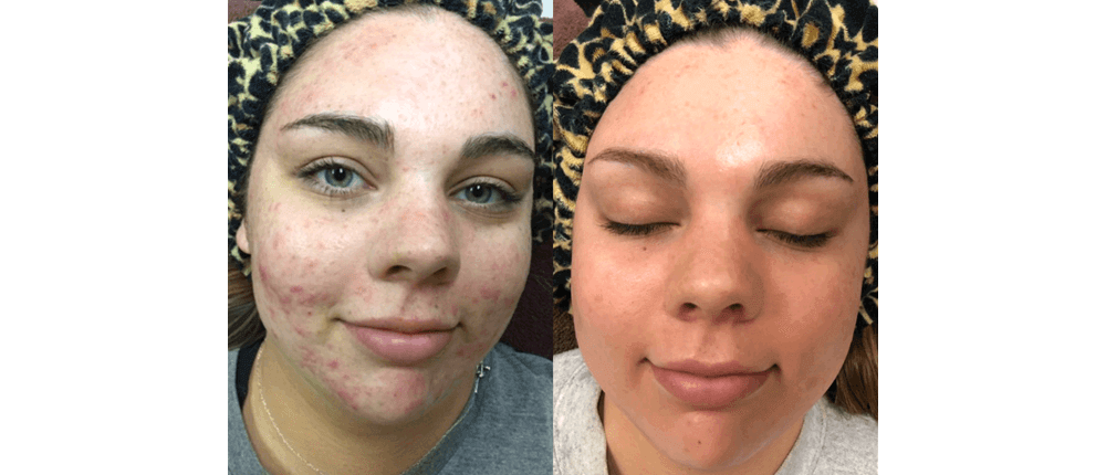 Before and After Skin Treatment at Reveal Salon