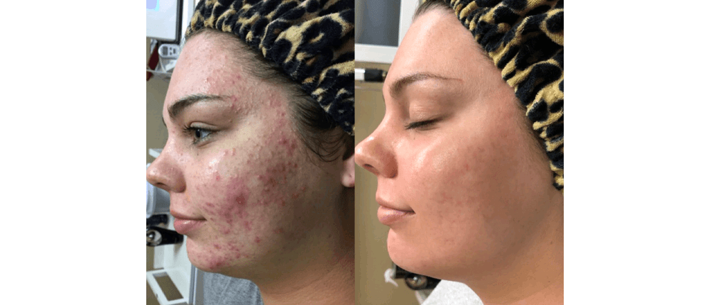 Before and After Skin Treatment at Reveal Salon