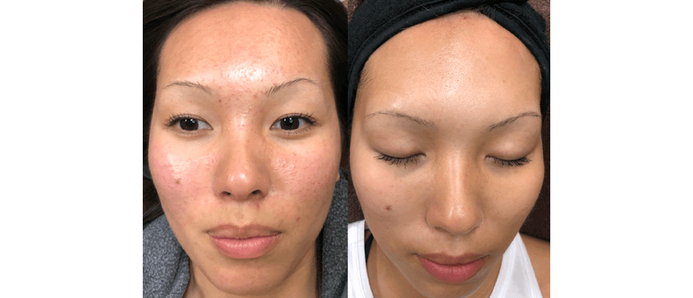 Before and After Skin Treatment at Reveal Salon