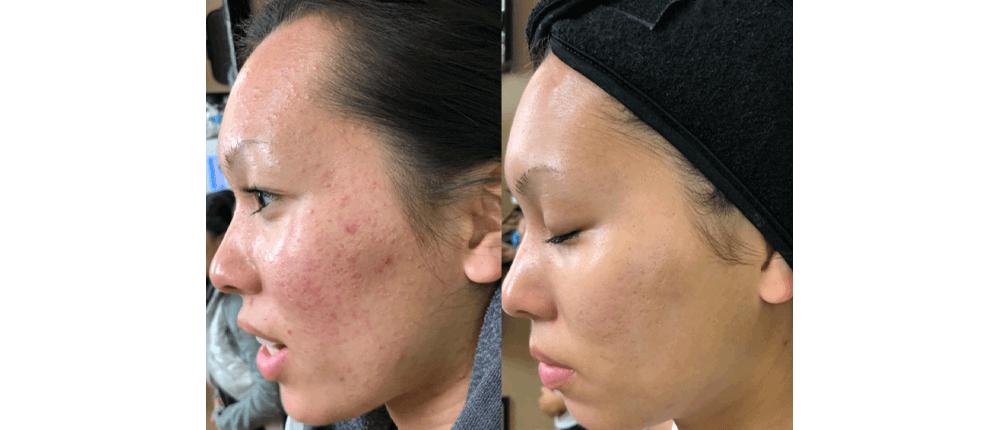 Before and After Skin Treatment at Reveal Salon