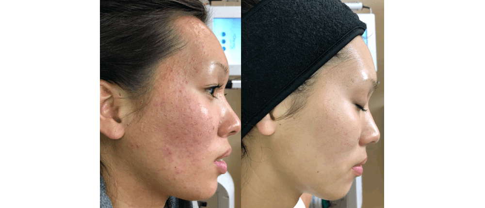 Before and After Skin Treatment at Reveal Salon