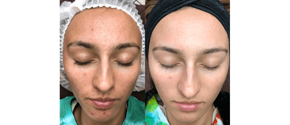 Before and After Skin Treatment at Reveal Salon