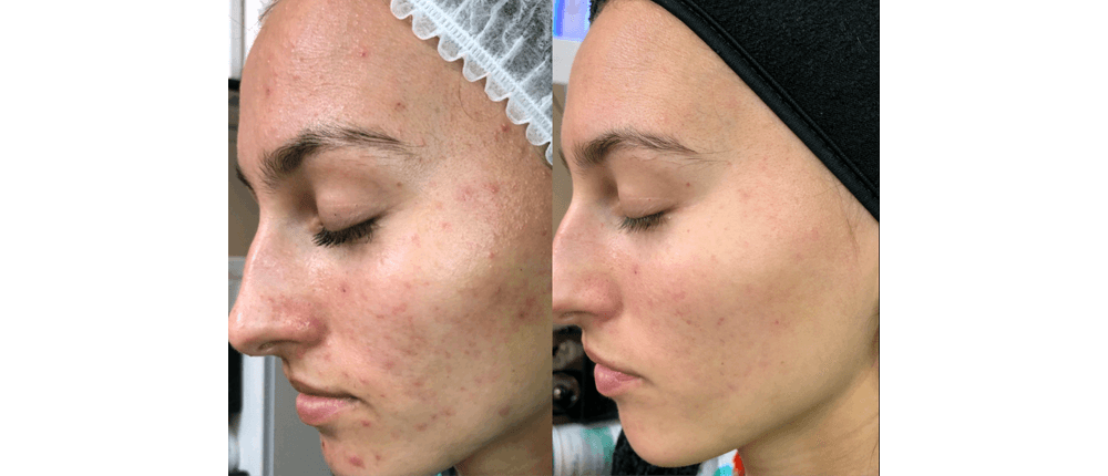 Before and After Skin Treatment at Reveal Salon