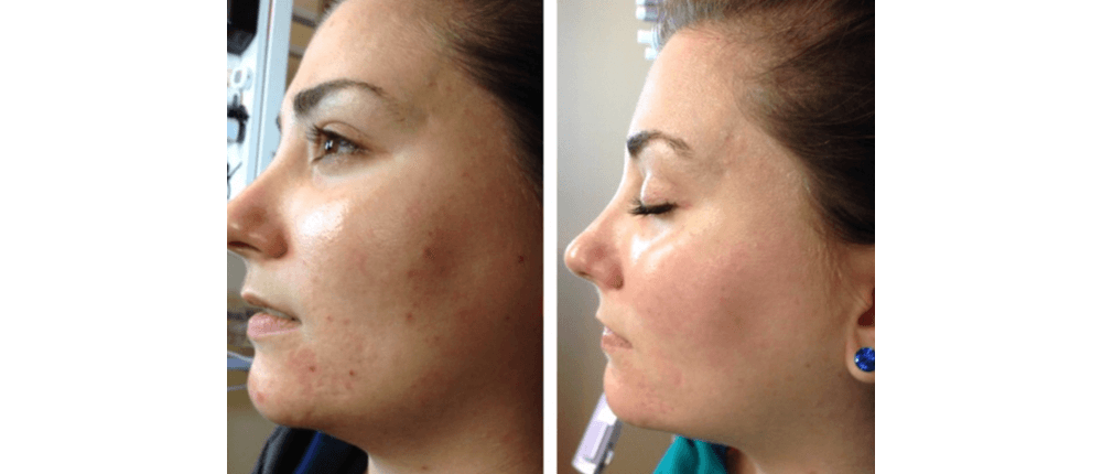 Before and After Skin Treatment at Reveal Salon