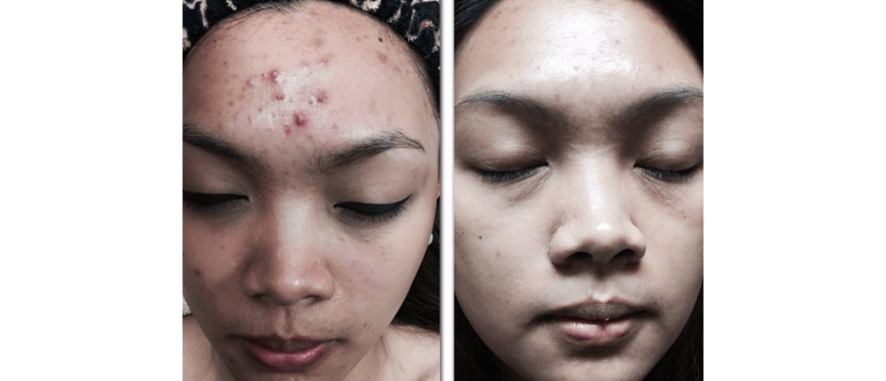 Before and After Skin Treatment at Reveal Salon